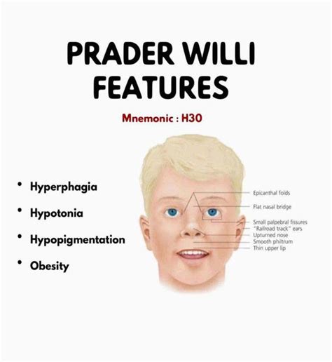 prada billy syndrome|newborn prader willi syndrome.